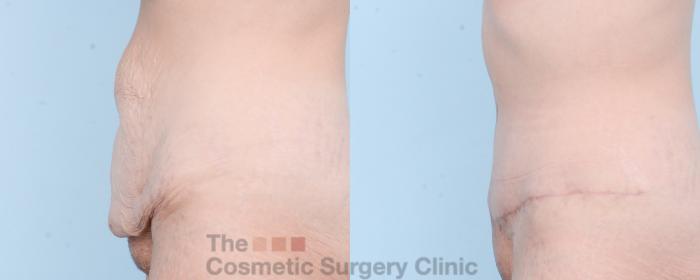 Before & After Tummy Tuck Case 875 Left Side View in Waterloo, Ontario