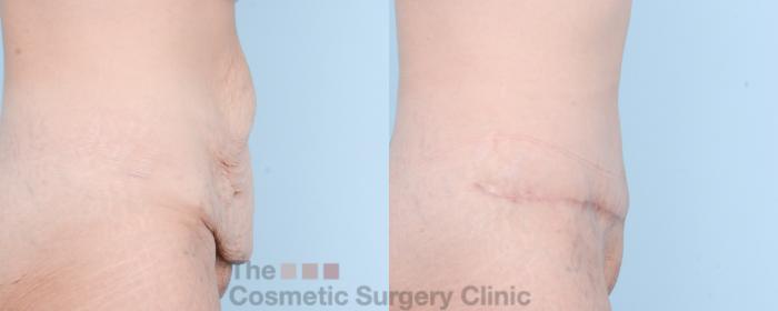 Before & After Tummy Tuck Case 875 Right Side View in Waterloo, Ontario
