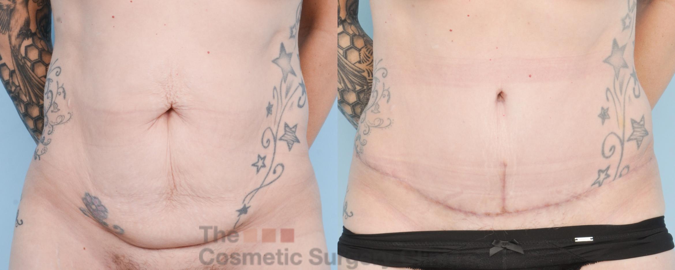 Before & After Tummy Tuck Case 880 Front View in Waterloo, Ontario