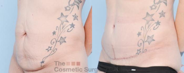 Before & After Tummy Tuck Case 880 Left Oblique View in Waterloo, Ontario