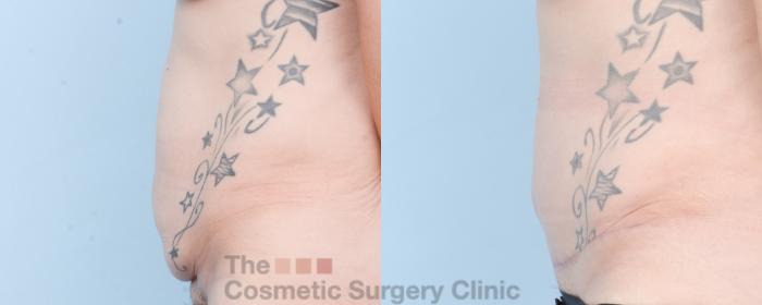 Before & After Tummy Tuck Case 880 Left Side View in Waterloo, Ontario