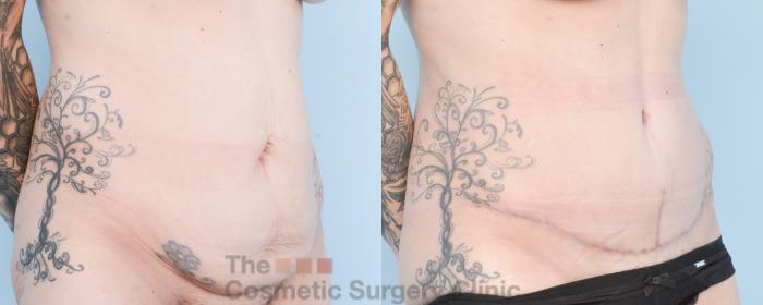 Before & After Tummy Tuck Case 880 Right Oblique View in Waterloo, Ontario