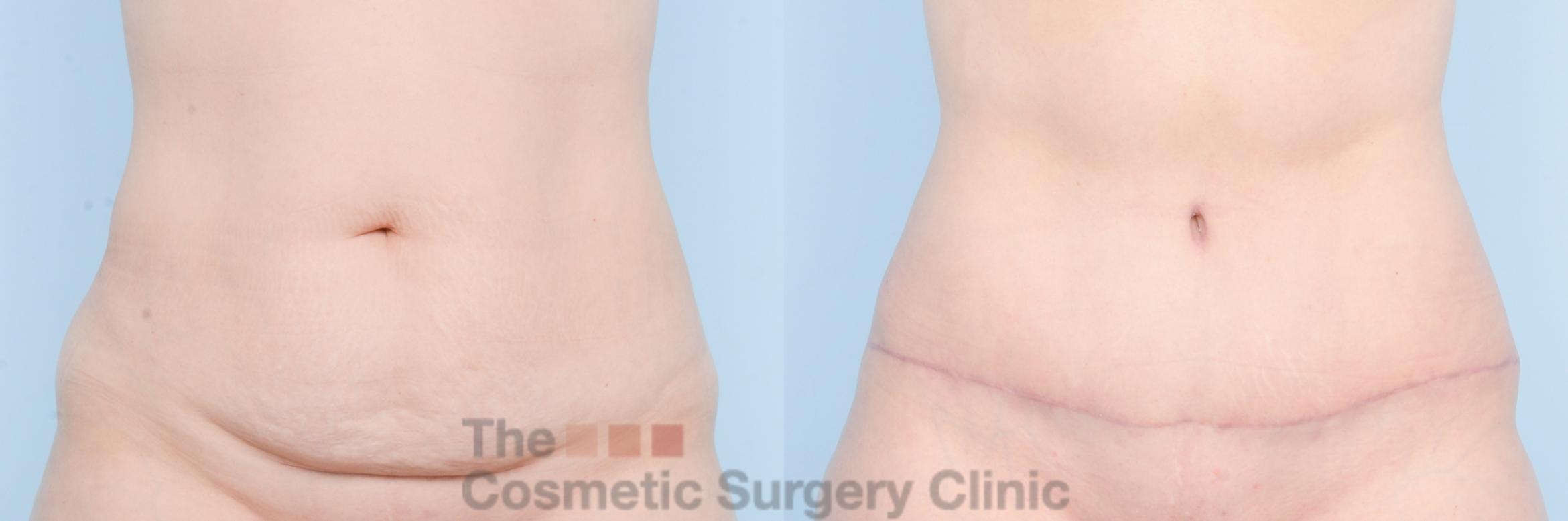 Before & After Tummy Tuck Case 886 Front View in Waterloo, Ontario