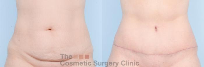 Before & After Tummy Tuck Case 886 Front View in Waterloo, Ontario