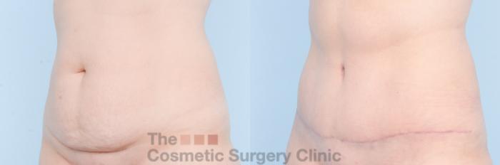 Before & After Tummy Tuck Case 886 Left Oblique View in Waterloo, Ontario
