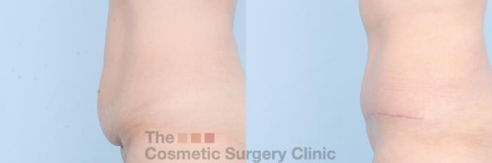 Before & After Tummy Tuck Case 886 Left Side View in Waterloo, Ontario