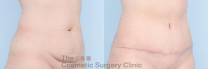 Before & After Tummy Tuck Case 886 Right Oblique View in Waterloo, Ontario