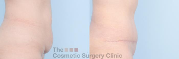 Before & After Tummy Tuck Case 886 Right Side View in Waterloo, Ontario