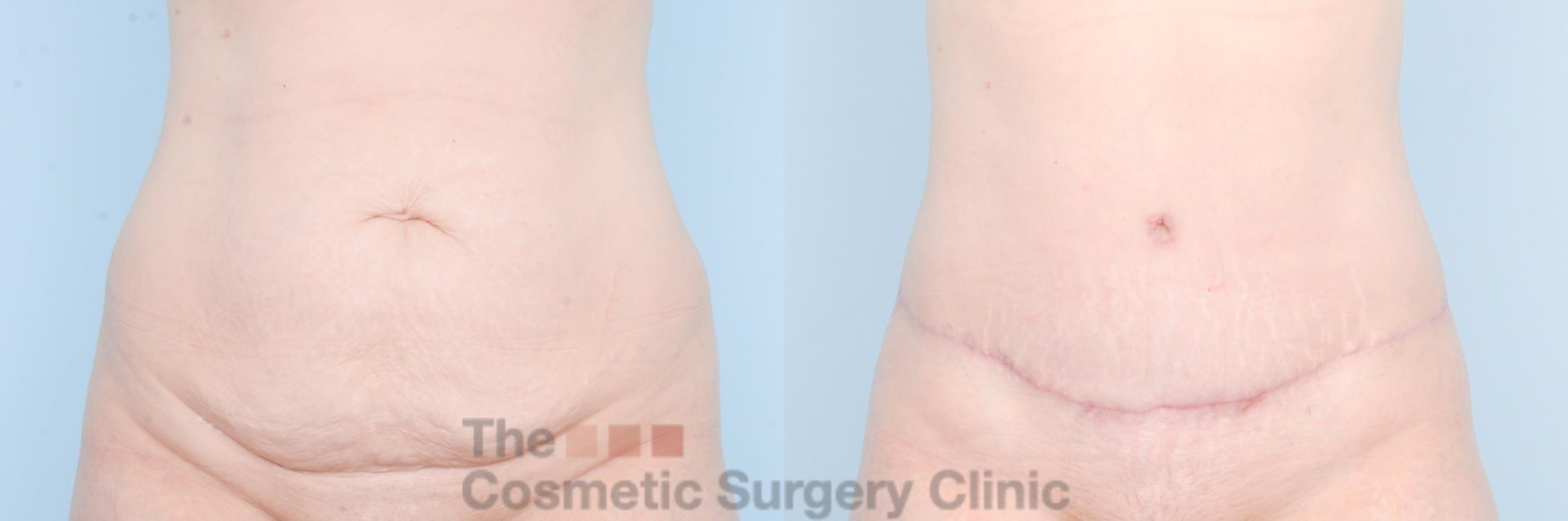 Before & After Tummy Tuck Case 887 Front View in Waterloo, Ontario