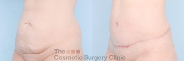 Before & After Tummy Tuck Case 887 Left Oblique View in Waterloo, Ontario