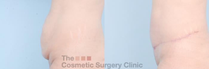 Before & After Tummy Tuck Case 887 Left Side View in Waterloo, Ontario