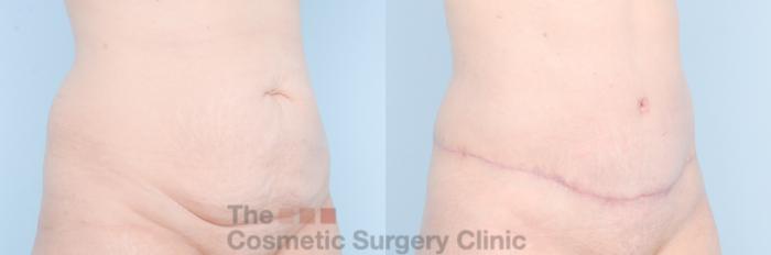 Before & After Tummy Tuck Case 887 Right Oblique View in Waterloo, Ontario