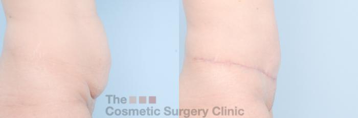 Before & After Tummy Tuck Case 887 Right Side View in Waterloo, Ontario