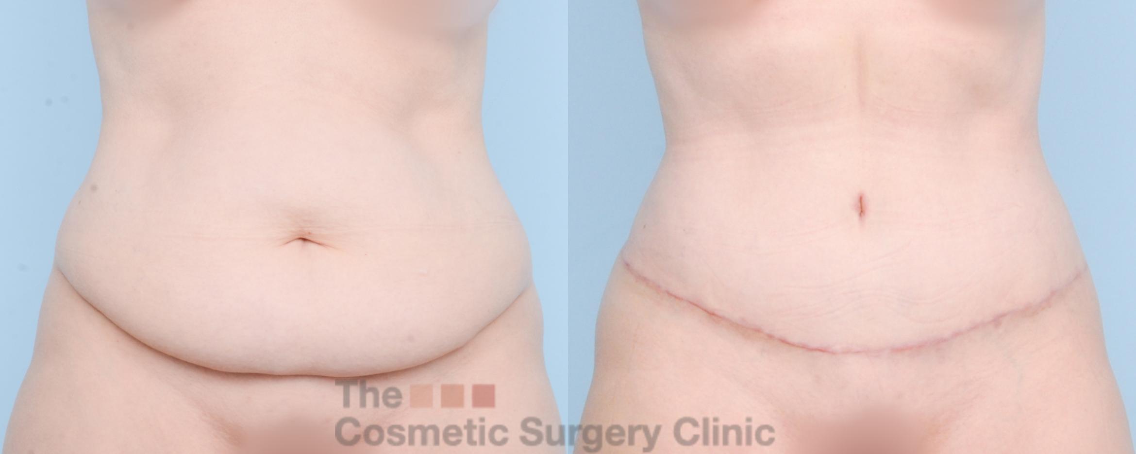 Before & After Tummy Tuck Case 889 Front View in Waterloo, Ontario