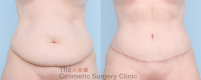 Before & After Tummy Tuck Case 889 Front View in Waterloo, Ontario