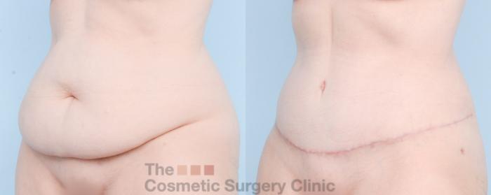 Before & After Tummy Tuck Case 889 Left Oblique View in Waterloo, Ontario