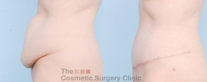 Before & After Tummy Tuck Case 889 Left Side View in Waterloo, Ontario
