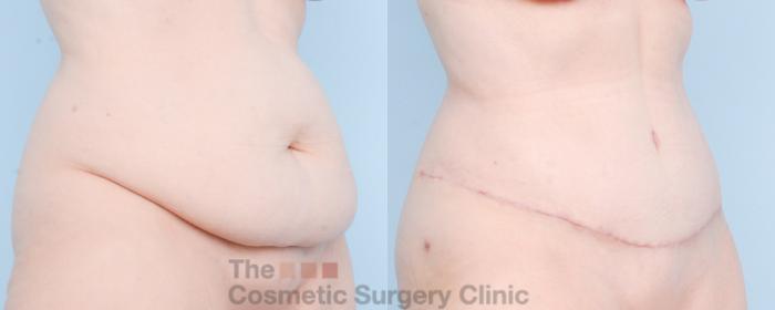 Before & After Tummy Tuck Case 889 Right Oblique View in Waterloo, Ontario