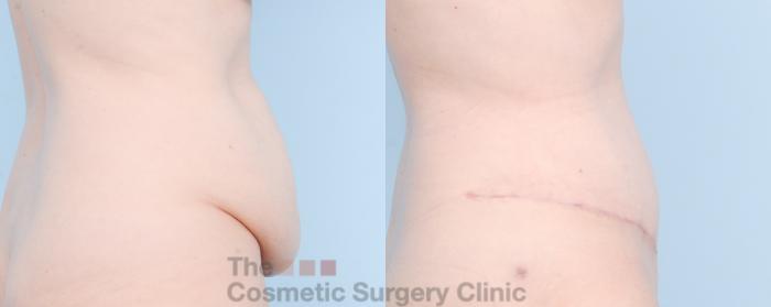 Before & After Tummy Tuck Case 889 Right Side View in Waterloo, Ontario