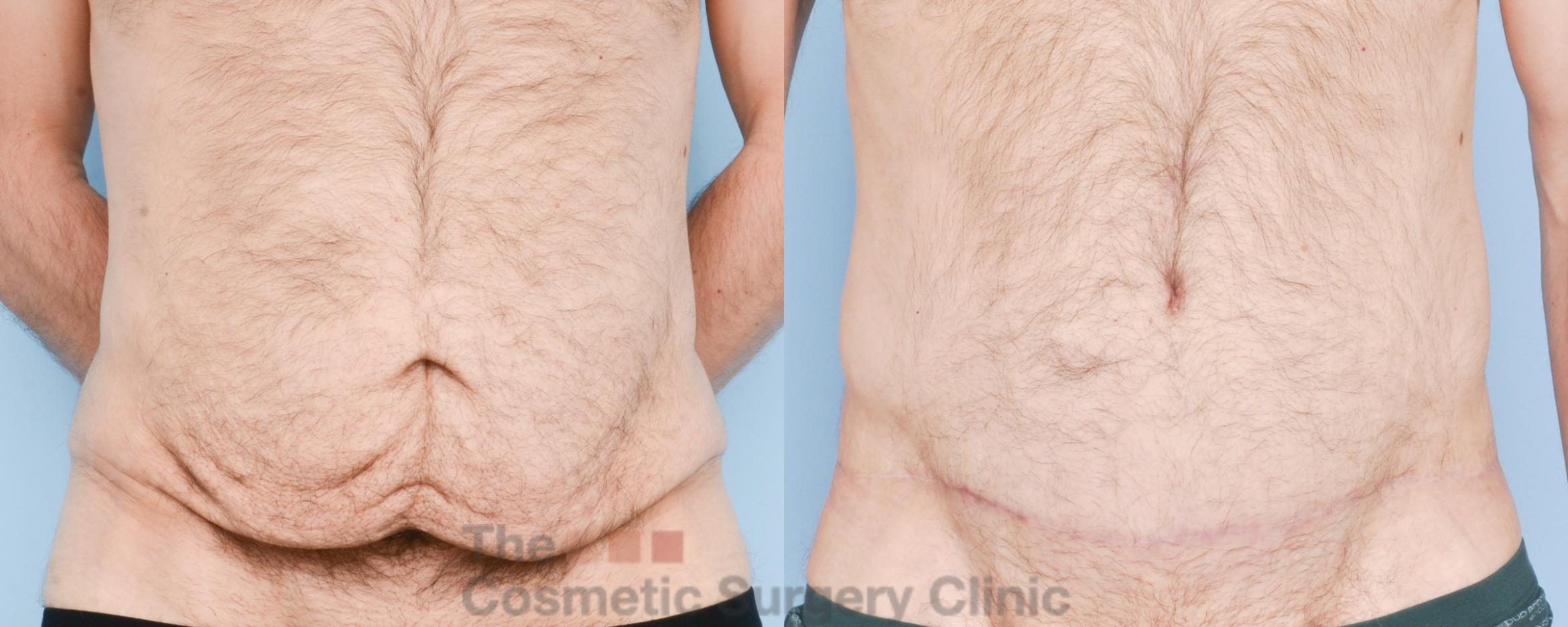 Before & After Tummy Tuck Case 890 Front View in Waterloo, Ontario