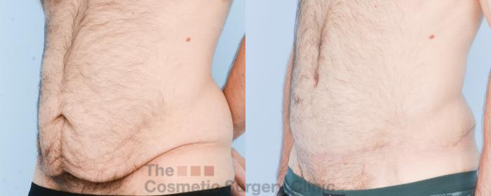 Before & After Tummy Tuck Case 890 Left Oblique View in Waterloo, Ontario