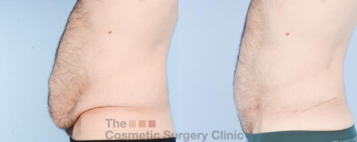 Before & After Tummy Tuck Case 890 Left Side View in Waterloo, Ontario