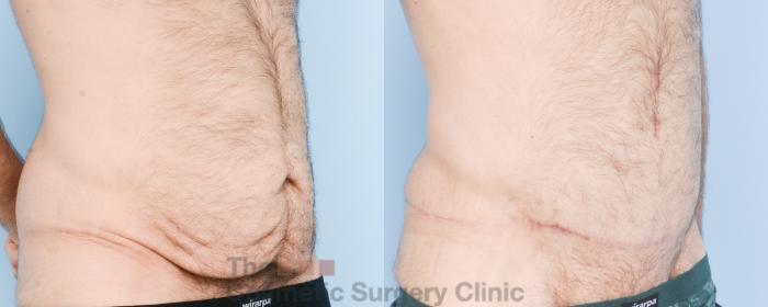 Before & After Tummy Tuck Case 890 Right Oblique View in Waterloo, Ontario