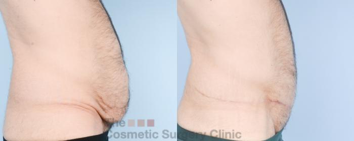 Before & After Tummy Tuck Case 890 Right Side View in Waterloo, Ontario