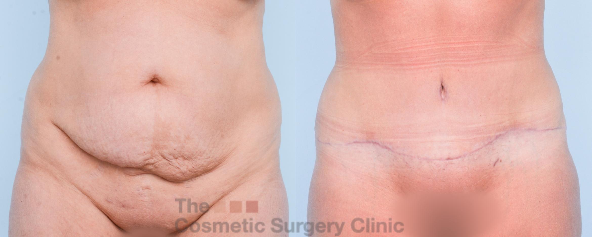 Before & After Tummy Tuck Case 903 Front View in Waterloo, Ontario