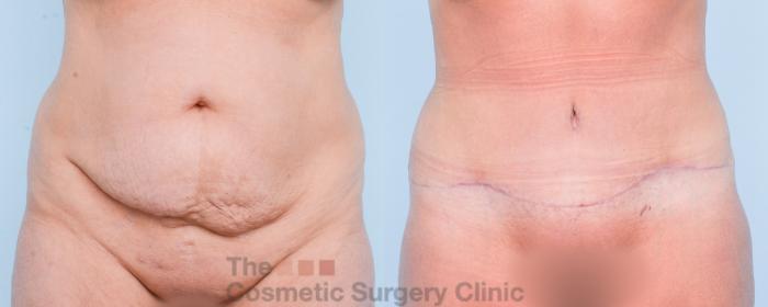 Before & After Tummy Tuck Case 903 Front View in Waterloo, Ontario