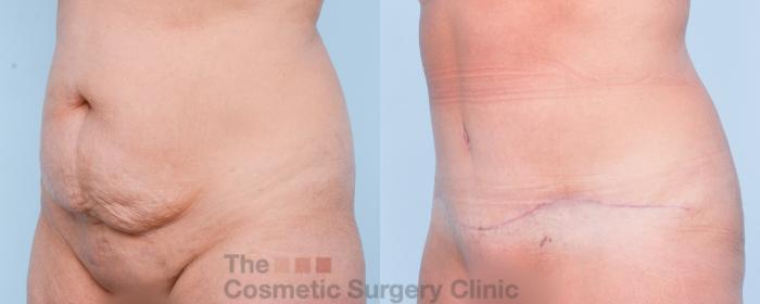 Before & After Tummy Tuck Case 903 Left Oblique View in Waterloo, Ontario