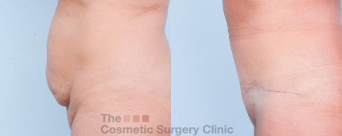 Before & After Tummy Tuck Case 903 Left Side View in Waterloo, Ontario