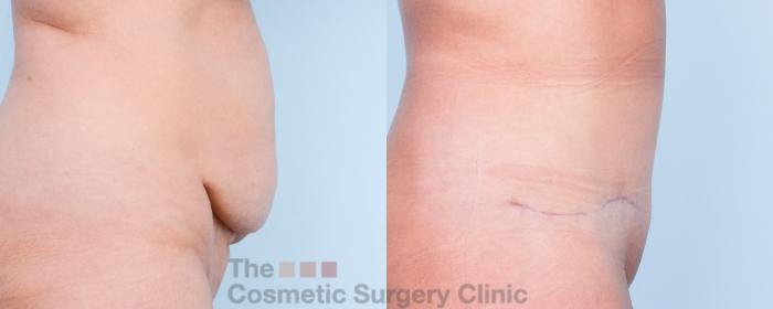 Before & After Tummy Tuck Case 903 Right Oblique View in Waterloo, Ontario