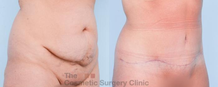 Before & After Tummy Tuck Case 903 Right Side View in Waterloo, Ontario