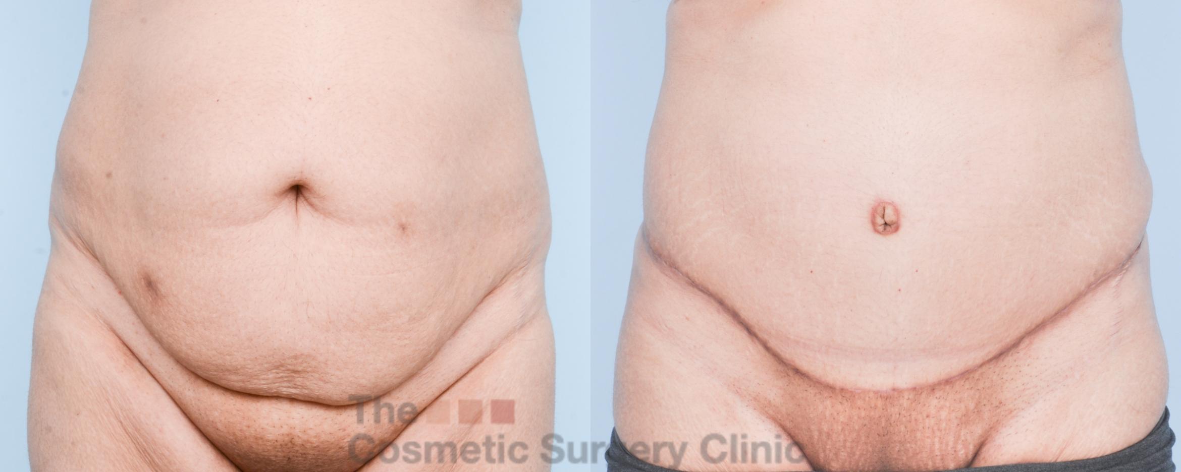Before & After Tummy Tuck Case 907 Front View in Waterloo, Ontario