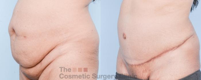 Before & After Tummy Tuck Case 907 Left Oblique View in Waterloo, Ontario