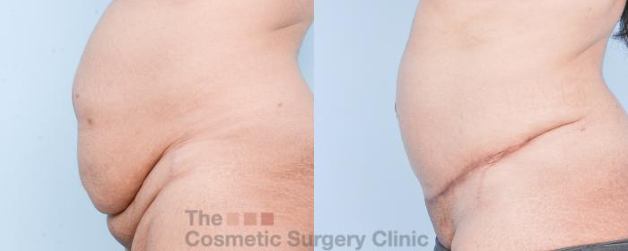 Before & After Tummy Tuck Case 907 Left Side View in Waterloo, Ontario