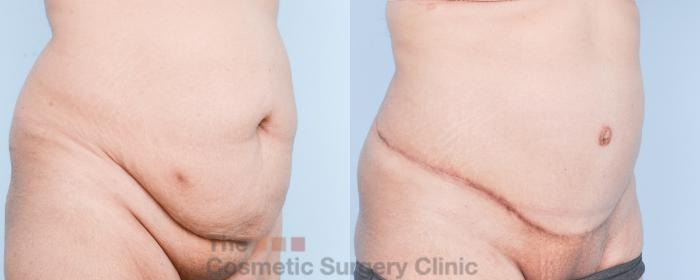 Before & After Tummy Tuck Case 907 Right Oblique View in Waterloo, Ontario