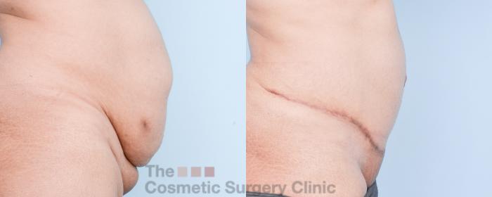 Before & After Tummy Tuck Case 907 Right Side View in Waterloo, Ontario