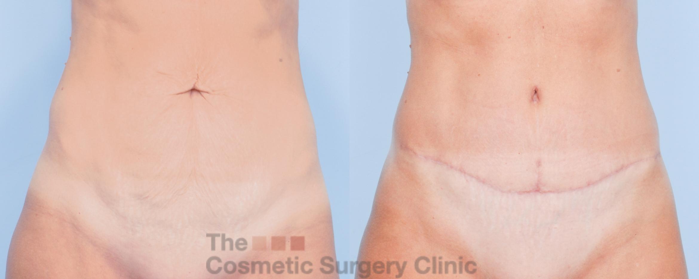 Before & After Tummy Tuck Case 913 Front View in Waterloo, Ontario