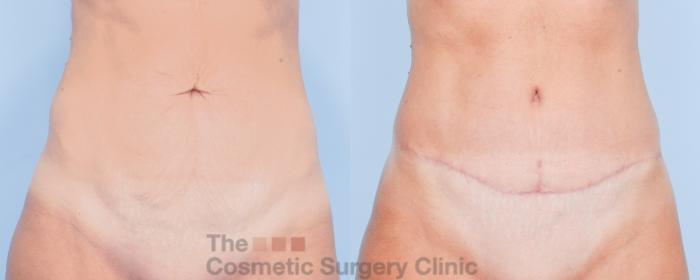 Before & After Tummy Tuck Case 913 Front View in Waterloo, Ontario