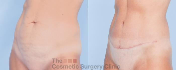 Before & After Tummy Tuck Case 913 Left Oblique View in Waterloo, Ontario