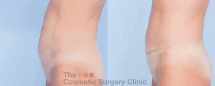 Before & After Tummy Tuck Case 913 Left Side View in Waterloo, Ontario