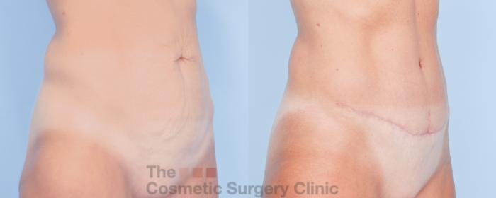 Before & After Tummy Tuck Case 913 Right Oblique View in Waterloo, Ontario