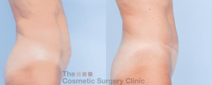 Before & After Tummy Tuck Case 913 Right Side View in Waterloo, Ontario