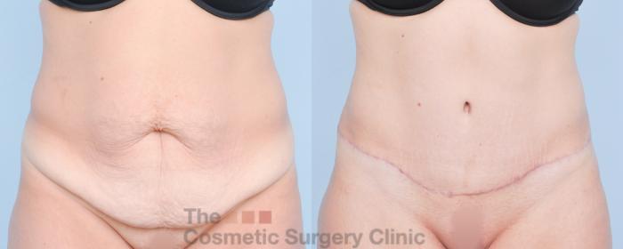 Before & After Tummy Tuck Case 917 Front View in Waterloo, Ontario