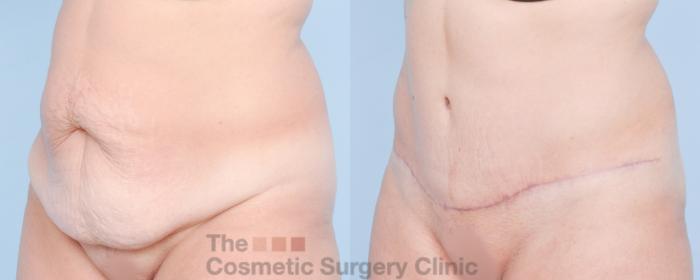 Before & After Tummy Tuck Case 917 Left Oblique View in Waterloo, Ontario