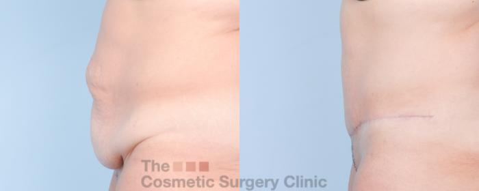 Before & After Tummy Tuck Case 917 Left Side View in Waterloo, Ontario