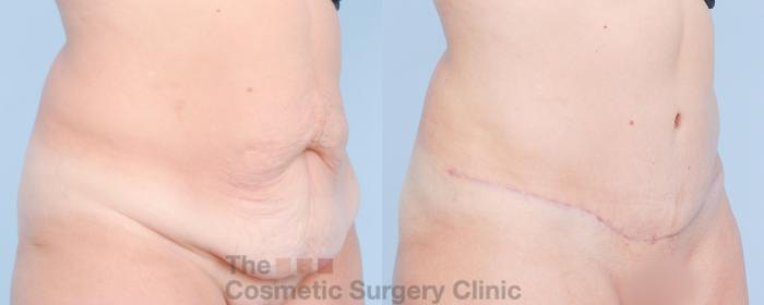 Before & After Tummy Tuck Case 917 Right Oblique View in Waterloo, Ontario