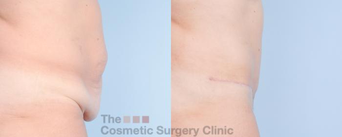 Before & After Tummy Tuck Case 917 Right Side View in Waterloo, Ontario